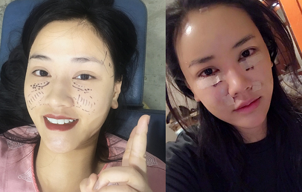 Maya lộ ảnh mặt sưng phù khi đi phẫu thuật thẩm mỹ ở Hàn Quốc