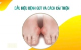 Dấu hiệu bệnh gút và cách cải thiện