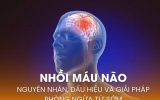 Nhồi máu não: Nguyên nhân, dấu hiệu và giải pháp phòng ngừa từ sớm
