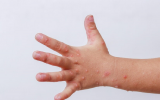 Bệnh tay chân miệng bùng phát và gia tăng nhanh