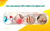 Các giai đoạn tiến triển của bệnh gút
