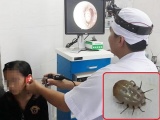 Hà Tĩnh: Bé gái suýt bị điếc vì bọ ve chó chui vào tai