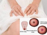 Những điều cần biết về viêm lộ tuyến cổ tử cung