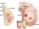 Nguyên nhân gây ra bệnh ung thư vú