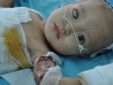 Tiếng kêu cứu của bé 2 tuổi hỏng mất 1 mắt vì ngã vào nồi canh