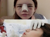 Khiếp đảm cô gái bị đột quỵ, mù mắt trái sau khi tiêm chất làm đầy nâng mũi