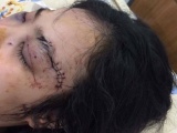 Nữ sinh bị cắt tai, đánh vỡ giác mạc vì tố giác tội phạm