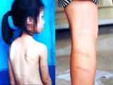 Nghệ An: Cô giáo đánh học sinh thâm tím lưng và chân vì không làm được bài
