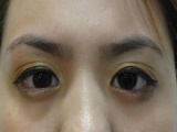 Ca mổ mắt của bác sĩ Việt giúp cô gái Mỹ thoát nguy cơ bị mù