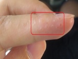 Hạt nhỏ li ti xuất hiện trên ngón tay: Vì sao phải thải độc ngay?