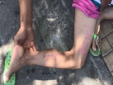 Phú Yên: Bé gái 9 tuổi bị thương gót chân, bác sĩ phẫu thuật khiến chân biến dạng