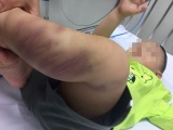 Hà Nội: Nghi vấn bé trai 1 tuổi bị bạo hành dã man và bỏ rơi ở bệnh viện