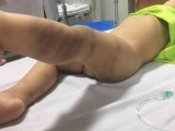 Bé trai bị bạo hành ở Hà Nội được xuất viện