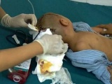 Thái Bình: Bé trai 3 tuổi bị tụ máu 1/4 não sau giờ học ở trường mầm non