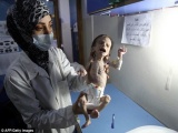 Syria: Bức hình em bé gầy trơ xương khiến cả thế giới rúng động