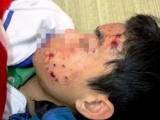 Nghệ An: Điện thoại phát nổ làm bé trai bị thương nặng