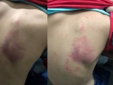 Hải Phòng: Cô giáo đánh học sinh tím lưng bị đình chỉ dạy học