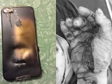 Bắc Giang: Vừa lướt mạng vừa sạc, iPhone phát nổ nát tay người đàn ông