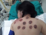 Hà Nội: Người phụ nữ bị hoại tử da khi đi giác hơi