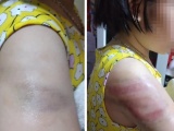Nam Định: Viết bài chậm, một học sinh bị cô giáo đánh bầm tím tay
