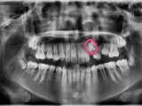 Phú Thọ: Phẫu thuật lấy gần 20 chiếc răng trong khối u của bé gái