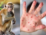 Việt Nam ghi nhận ca tử vong đầu tiên liên quan bệnh đậu mùa khỉ