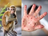 Bộ Y tế đề nghị tiếp tục giám sát, phát hiện sớm người mắc bệnh đậu mùa khỉ