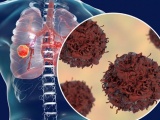 Tumolung – Bước đột phá trong việc phòng ngừa và hỗ trợ điều trị ung thư phổi