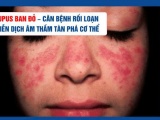 Lupus ban đỏ – Căn bệnh rối loạn miễn dịch âm thầm tàn phá cơ thể