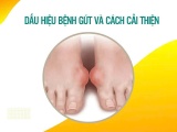 Dấu hiệu bệnh gút và cách cải thiện