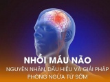 Nhồi máu não: Nguyên nhân, dấu hiệu và giải pháp phòng ngừa từ sớm