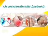 Các giai đoạn tiến triển của bệnh gút