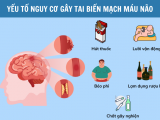Nguyên nhân tai biến mạch máu não: 6 yếu tố nguy cơ nhiều người đang bỏ qua
