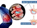 Thoát vị đĩa đệm L4 L5 chèn ép dây thần kinh: Đừng chủ quan với cơn đau lan xuống chân