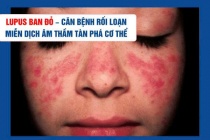 Lupus ban đỏ – Căn bệnh rối loạn miễn dịch âm thầm tàn phá cơ thể