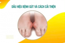 Dấu hiệu bệnh gút và cách cải thiện