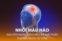 Nhồi máu não: Nguyên nhân, dấu hiệu và giải pháp phòng ngừa từ sớm