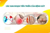 Các giai đoạn tiến triển của bệnh gút