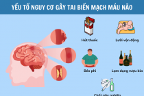 Nguyên nhân tai biến mạch máu não: 6 yếu tố nguy cơ nhiều người đang bỏ qua