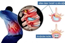 Thoát vị đĩa đệm L4 L5 chèn ép dây thần kinh: Đừng chủ quan với cơn đau lan xuống chân