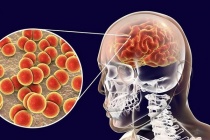 Những điều cần biết về bệnh do não mô cầu, người dân cần chủ động phòng tránh 