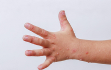 Bệnh tay chân miệng bùng phát và gia tăng nhanh