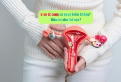 U xơ tử cung có nguy hiểm không? Điều trị như thế nào?