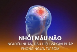 Nhồi máu não: Nguyên nhân, dấu hiệu và giải pháp phòng ngừa từ sớm