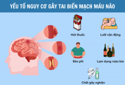 Nguyên nhân tai biến mạch máu não: 6 yếu tố nguy cơ nhiều người đang bỏ qua