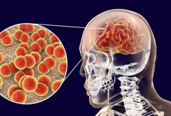 Những điều cần biết về bệnh do não mô cầu, người dân cần chủ động phòng tránh 