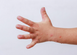 Bệnh tay chân miệng bùng phát và gia tăng nhanh