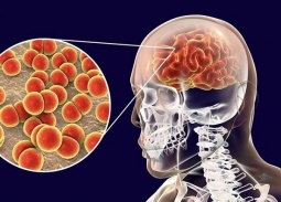 Những điều cần biết về bệnh do não mô cầu, người dân cần chủ động phòng tránh 