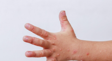 Bệnh tay chân miệng bùng phát và gia tăng nhanh