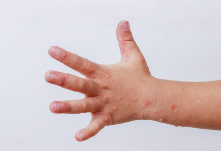 Bệnh tay chân miệng bùng phát và gia tăng nhanh